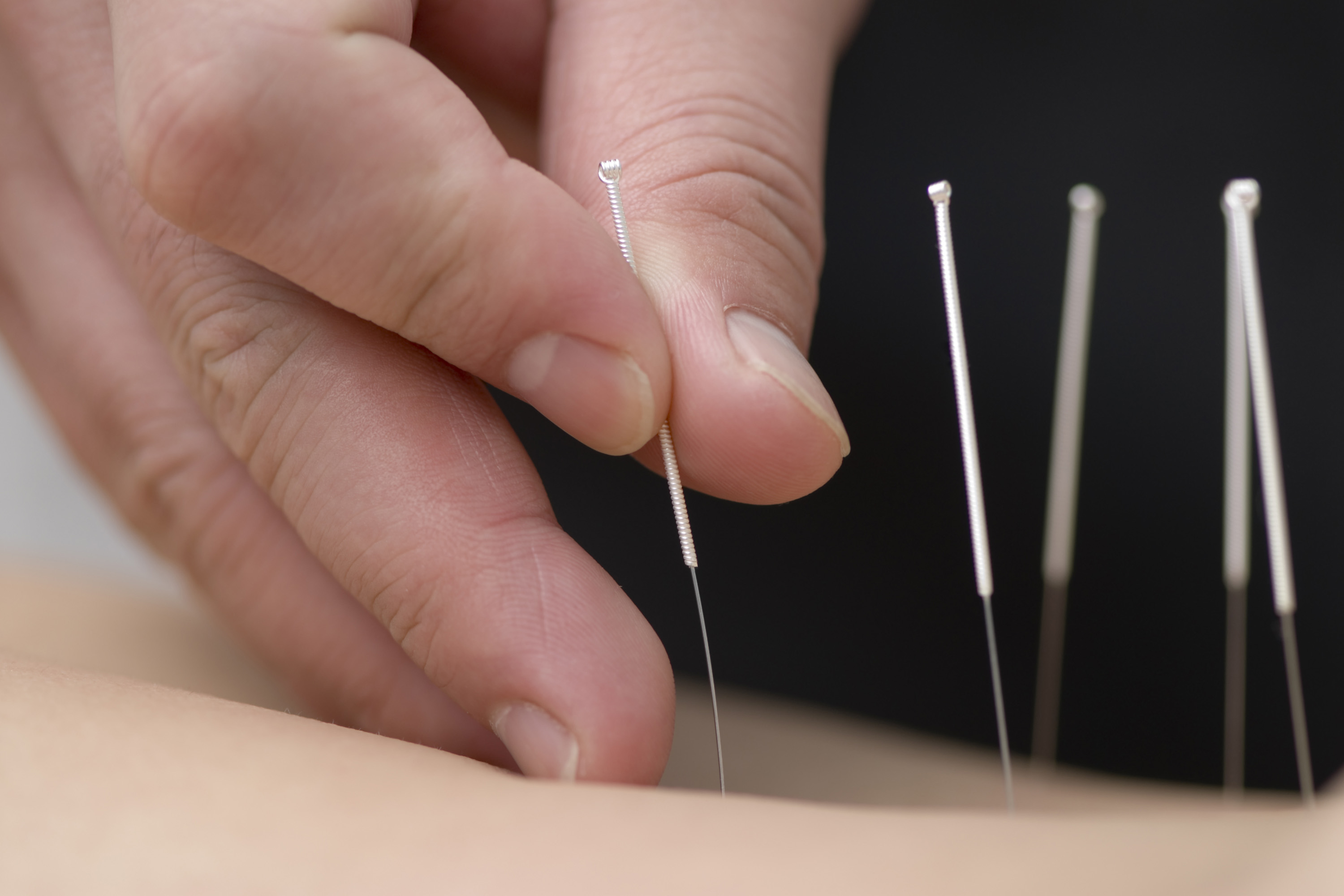 Os benefícios da massagem associada com a acupuntura