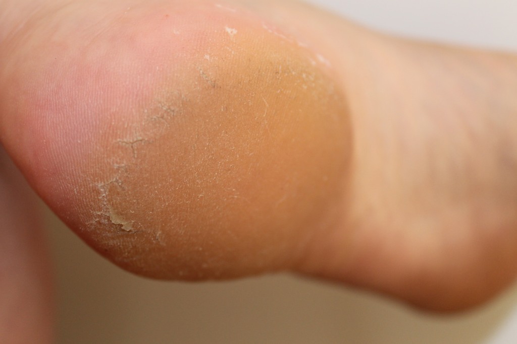 Diga adeus ao calcanhar rachado!